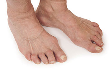 Arthritic foot and ankle care treatment in the Suffolk County, NY: Smithtown, Brentwood, Central Islip, Hauppauge, Lake Grove, Kings Park, Сommack, Ronkonkoma, Holbrook, Holtsville, Farmingville, Selden NY areas