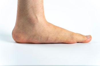 Flat Feet and Fallen Arches Treatment in the Suffolk County, NY: Smithtown, Brentwood, Central Islip, Hauppauge, Lake Grove, Kings Park, Сommack, Ronkonkoma, Holbrook, Holtsville, Farmingville, Selden NY areas