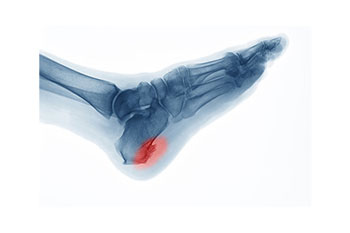 Heel spurs specialist in the Suffolk County, NY: Smithtown, Brentwood, Central Islip, Hauppauge, Lake Grove, Kings Park, Сommack, Ronkonkoma, Holbrook, Holtsville, Farmingville, Selden NY areas