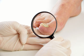 Toenail fungus treatment in the Suffolk County, NY: Smithtown, Brentwood, Central Islip, Hauppauge, Lake Grove, Kings Park, Сommack, Ronkonkoma, Holbrook, Holtsville, Farmingville, Selden NY areas