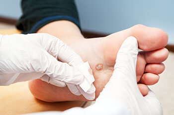 Plantar Warts Treatment in the Suffolk County, NY: Smithtown, Brentwood, Central Islip, Hauppauge, Lake Grove, Kings Park, Сommack, Ronkonkoma, Holbrook, Holtsville, Farmingville, Selden NY areas